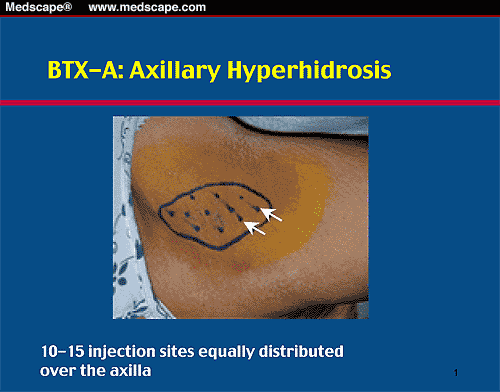 axillary hyperhidrosis