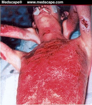 Effect of a Catabolic State With Involuntary Weight Loss 