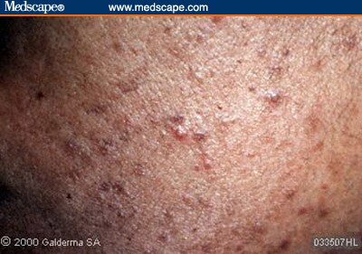 Acne and Rosacea: Differential Diagnosis and Treatment in the Primary ...