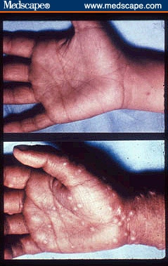 giant microbes smallpox