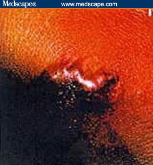 Medscape Personal Professor: Anthrax
