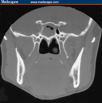 Runny Nose Headaches: Diagnosis Is the Key to Successful Treatment