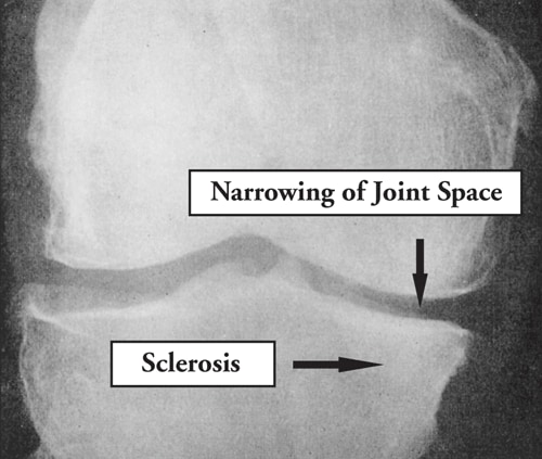 Management Of Osteoarthritis Knee Pain The State Of The Science