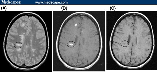 Mri Of Ms Lesions Images 3752