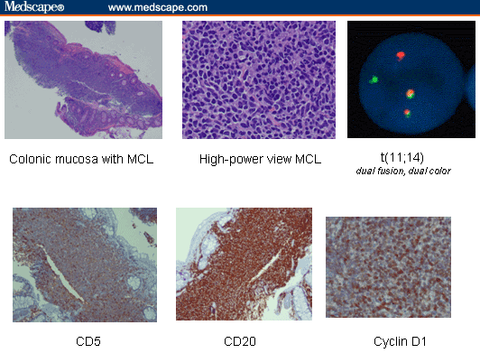 mantle-cell-lymphoma