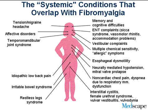 Fibromyalgia: Defining the Disorder, Diagnosis and Treatment