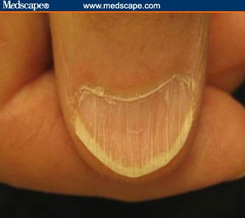 Examining The Fingernails When Evaluating Presenting Symptoms In 