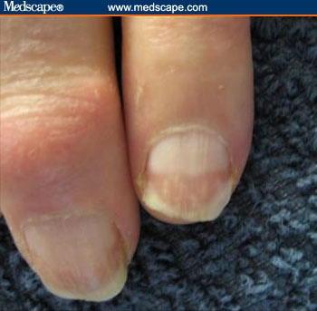 A homoeopathic approach for nail disorders with therapeutics