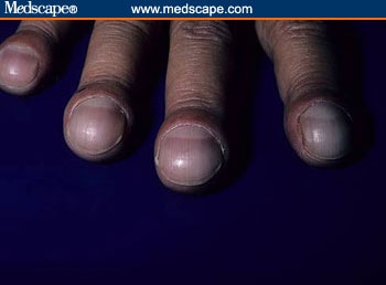 Pictures Of Spoon Shaped Nails examining the fingernails when evaluating presenting symptoms in elderly patients