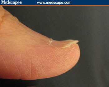 Examining the Fingernails