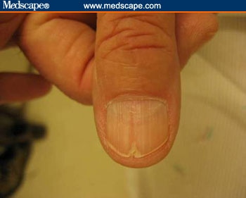 Examining the Fingernails