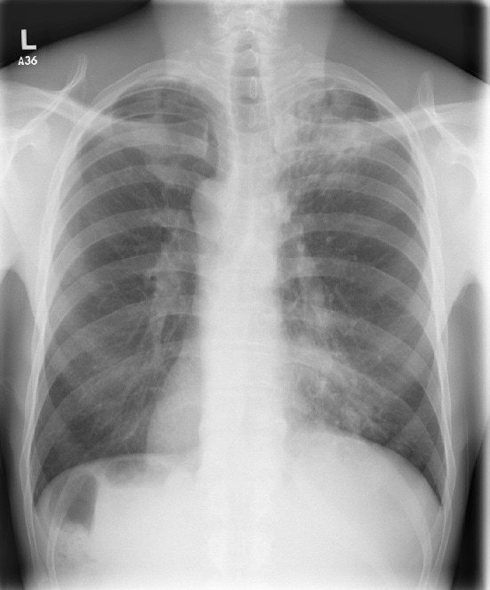 Pulmonary Tuberculosis With Tb Meningitis