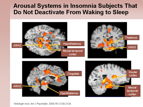 Recognizing And Managing Insomnia And Comorbid Conditions (Slides With ...