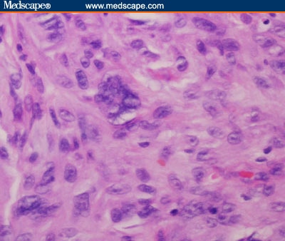 Less Common Cutaneous Malignancies