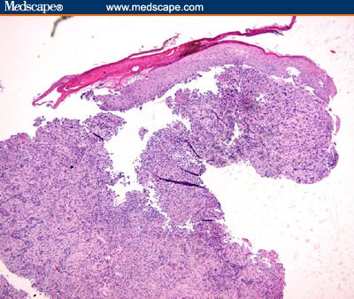 Less Common Cutaneous Malignancies