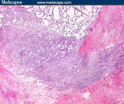 Less Common Cutaneous Malignancies