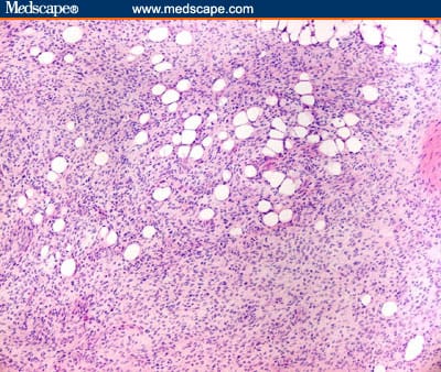 Less Common Cutaneous Malignancies