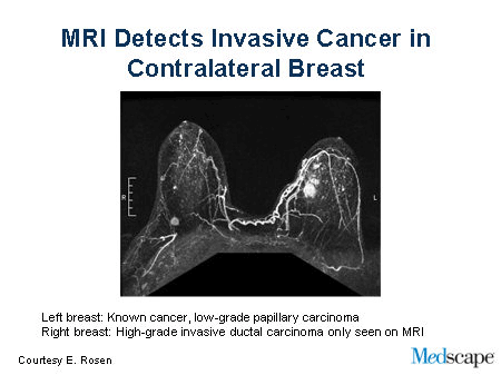 MRI for Patients With Breast Cancer (Slides with Transcript)