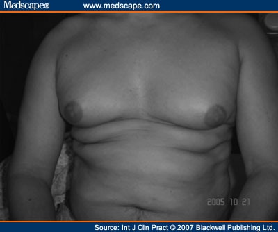 Management of Gynaecomastia An Update