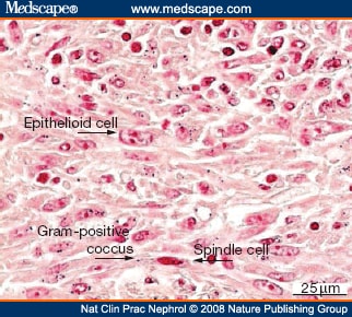 Pulmonary Mass Caused by Rhodococcus equi in a Renal Transplant Recipient