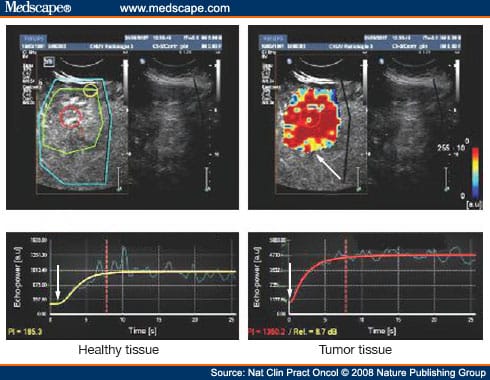 Biomarkers of Angiogenesis for the Development of Antiangiogenic Therapies