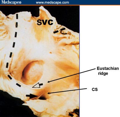 Eustachian Ridge Expert Interview - Spotlight on Left Ventricular Lead Implantation ...