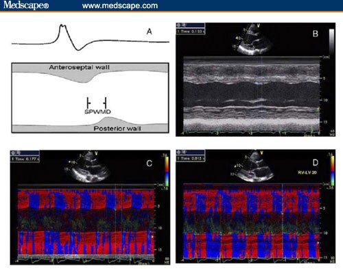 Expert Interview - Spotlight On Left Ventricular Lead Implantation ...