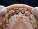 Periodontitis Linked to HPV-Positive Oral Tumors