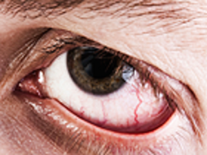 Dry Eye Common After Eyelid Lifts