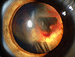 Fluoroquinolones Linked to Retinal Detachments