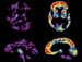 Mixed Reaction to CMS Decision on Amyloid PET Imaging