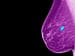Cryoablation 'Quite Successful' for Small Breast Cancers