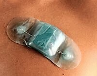 zio patch heart monitor