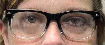 3d Printer Makes Mask In Hours For Eye Cancer Patients