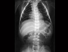 CHMP Backs Elosulfase Alfa (Vimizim) for Rare Morquio A Syndrome