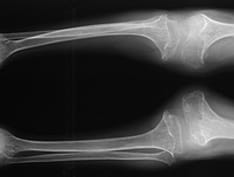 FDA Clears the First Drug for Rare Morquio A Syndrome