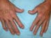 FDA OKs Tofacitinib (Xeljanz) for Active Psoriatic Arthritis