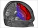 Imaging Shows Cognitive Processes in Vegetative Patients