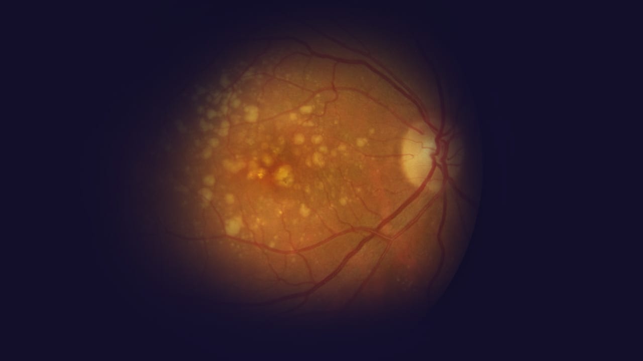 Clinical Advances in Dry AMD and Geographic Atrophy