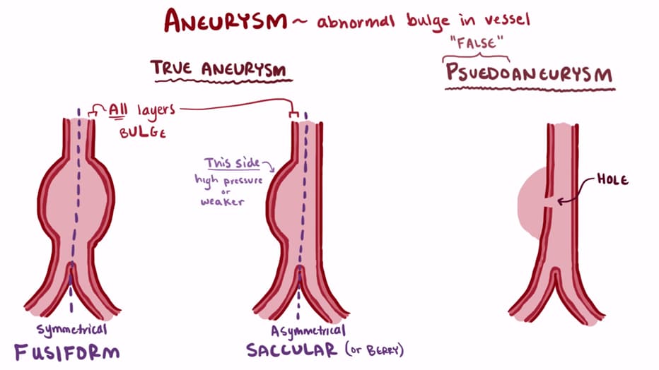 true aneurysm