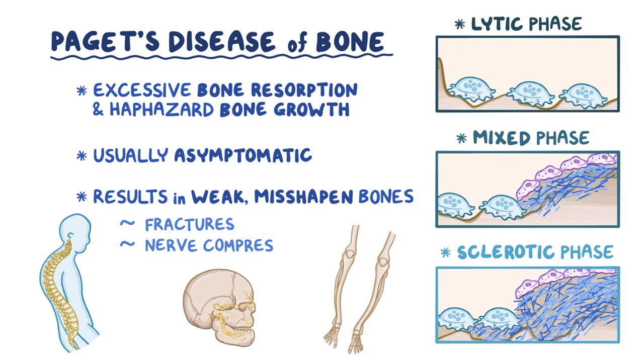 paget disease of the bone