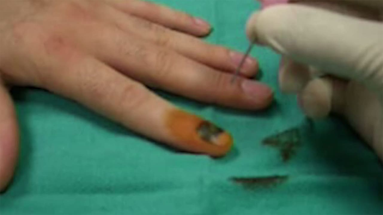 Top more than 100 nail trephination procedure best noithatsi.vn