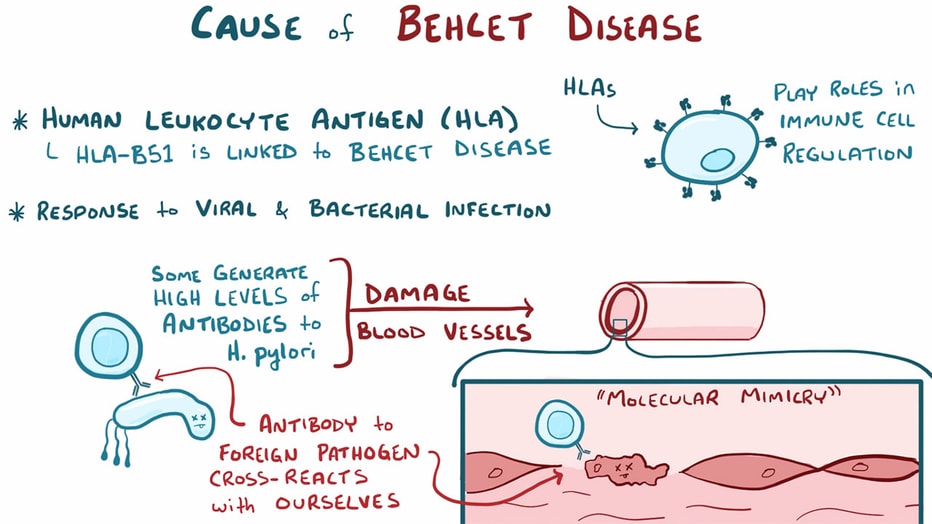 Behcet Disease: Overview Video
