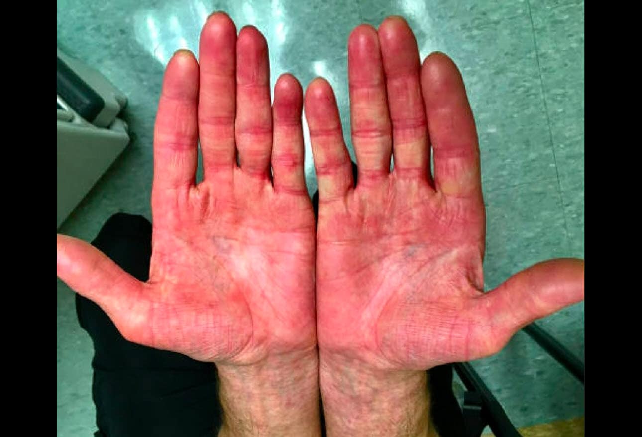 10 Erythema Conditions You Should Know