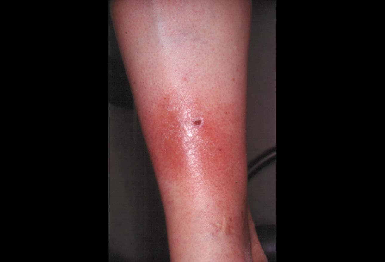 10 Erythema Conditions You Should Know