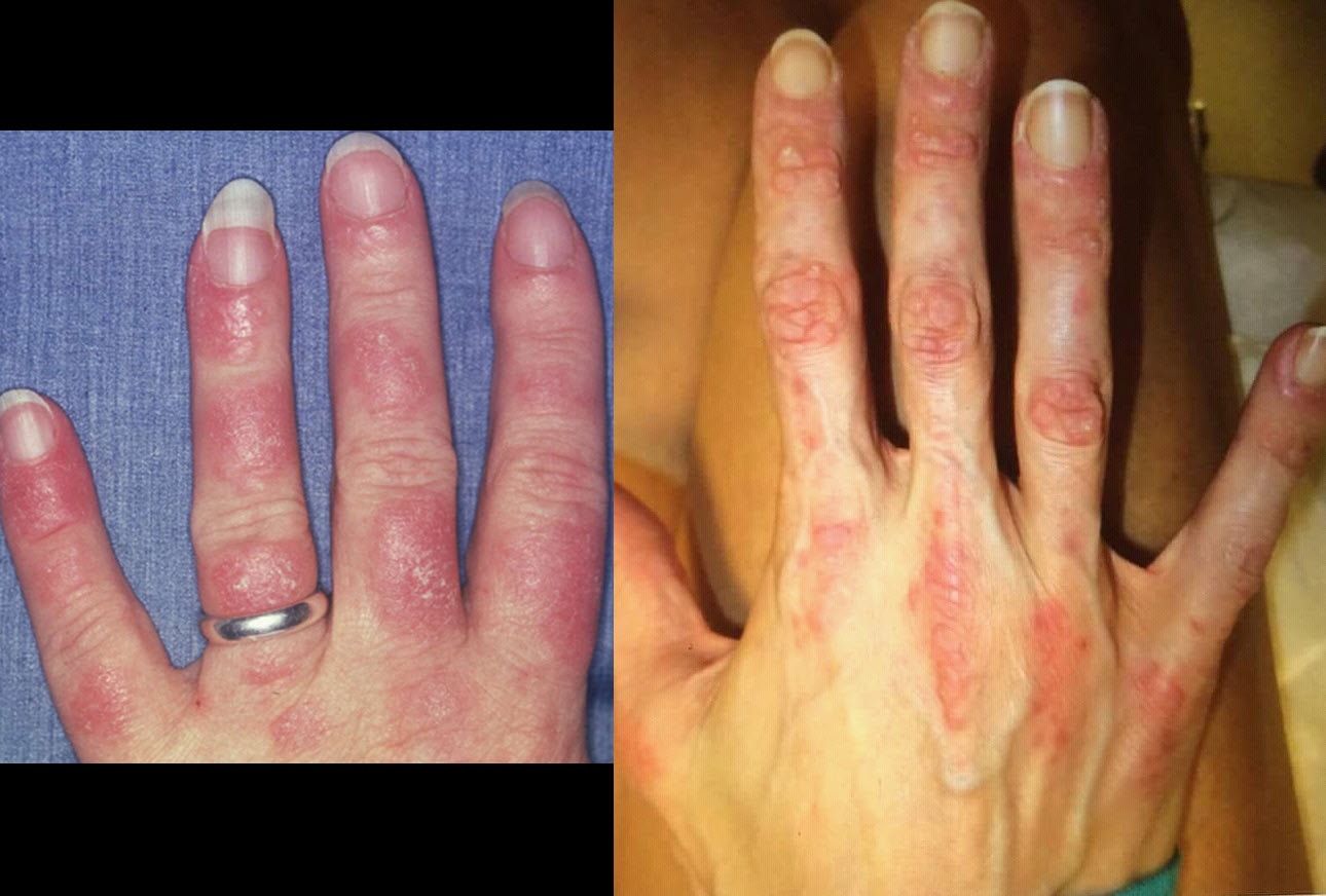10 Erythema Conditions You Should Know