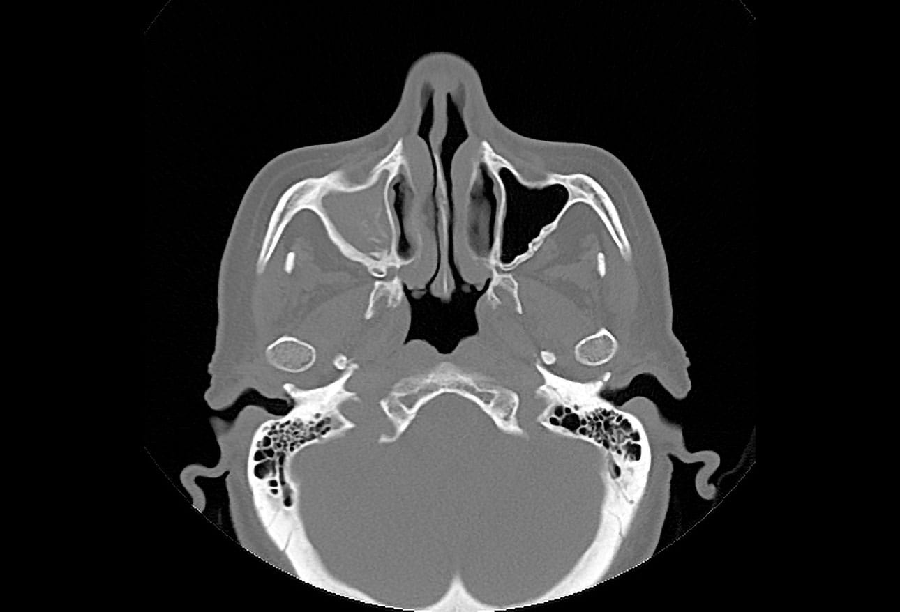Sinuscam Migraine vs Sinus Headache: Making the Diagnosis