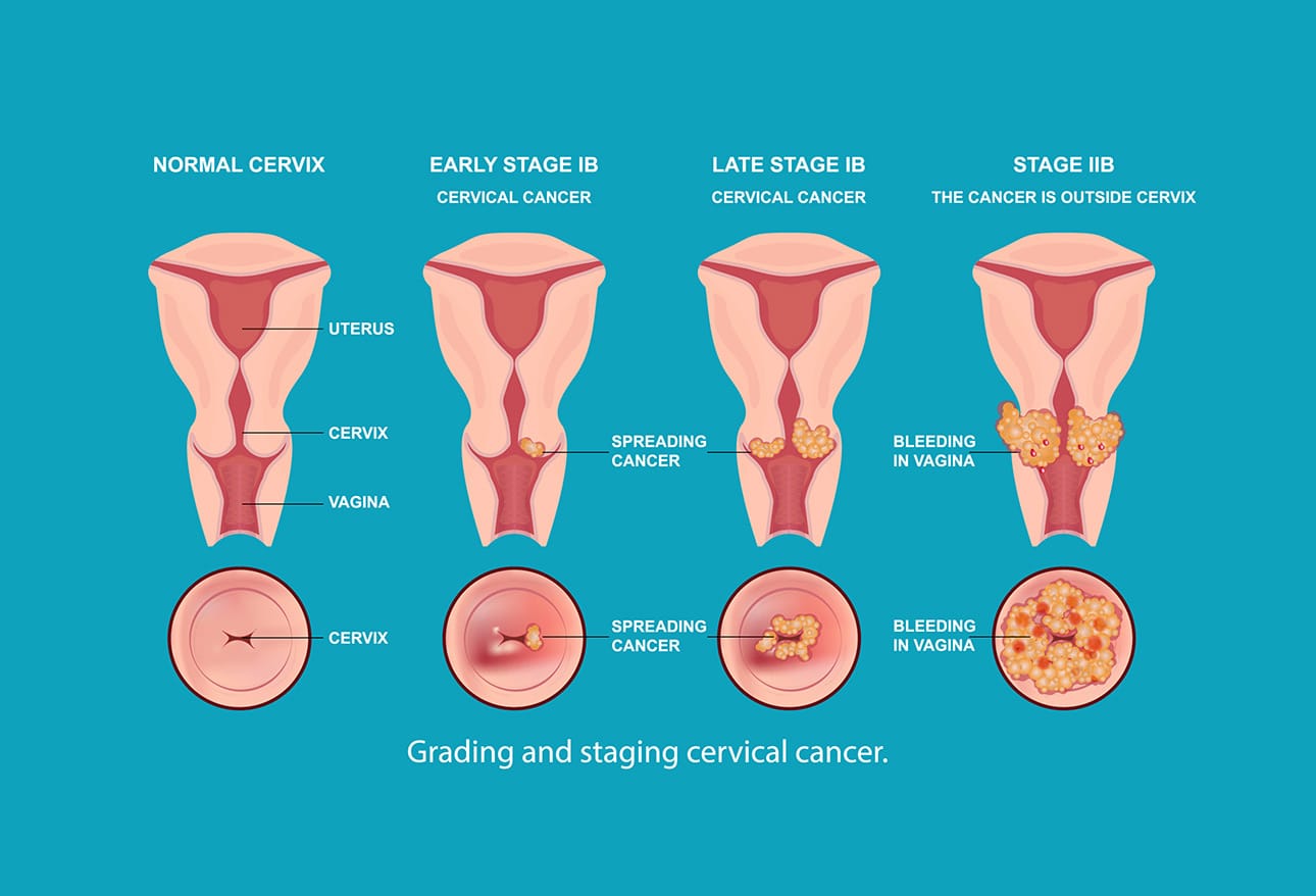 Can Cervical Cancer Spread To Uterus Can Cervical Cancer Spread To Uterus