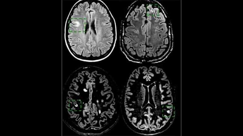 Multiple Sclerosis: Making the Diagnosis With MRI