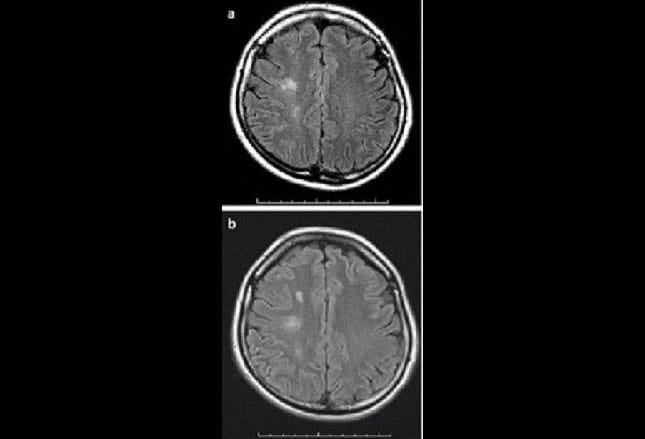 Multiple Sclerosis: Making the Diagnosis With MRI